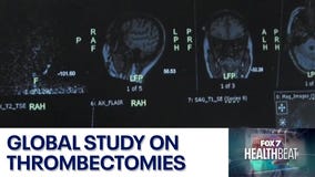 Global study on thrombectomies