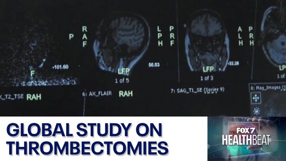 Global study on thrombectomies