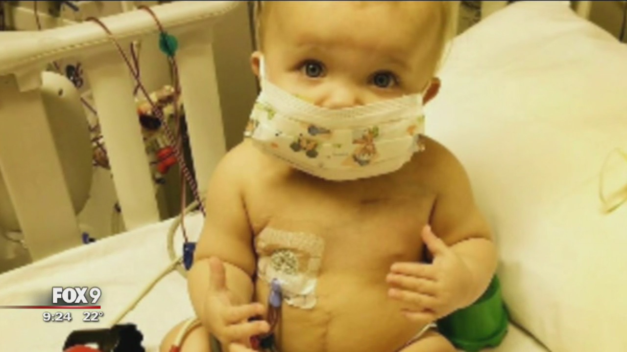 100 percent success rate for baby kidney transplants at U of M