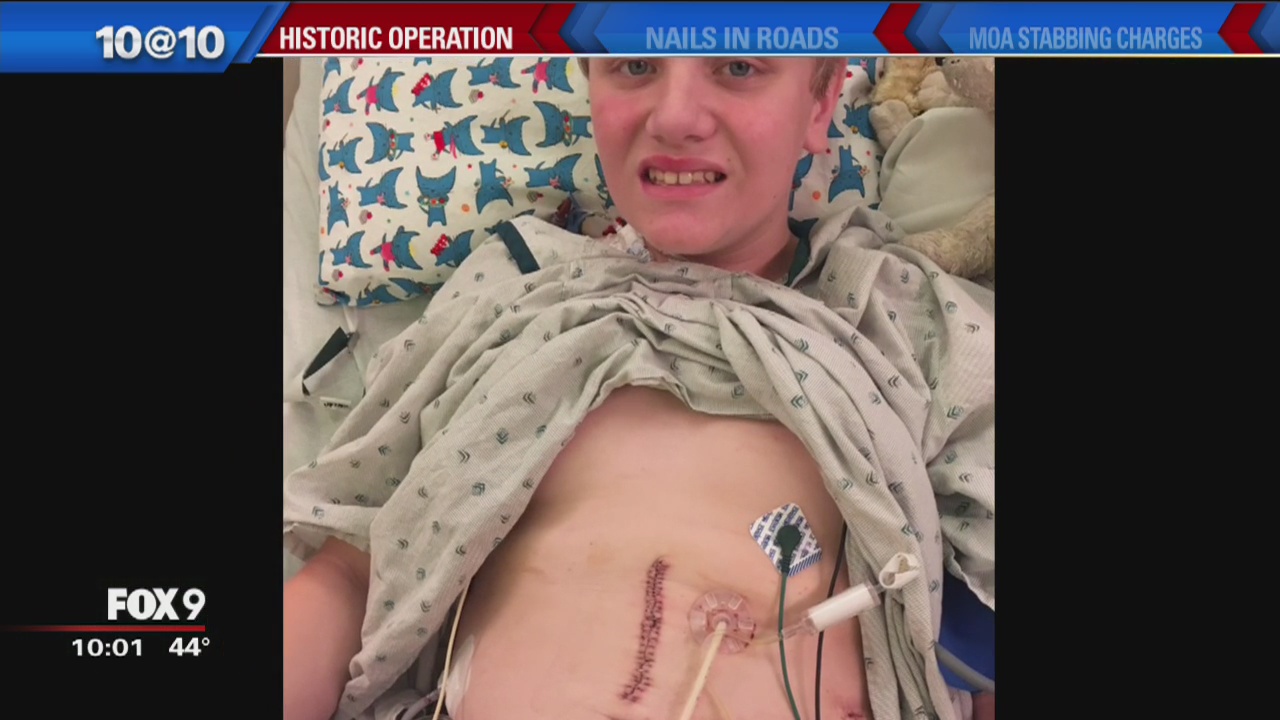 U of M pancreatitis procedure reaches major milestone