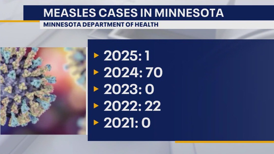 MDH identifies 1st measles case of 2025