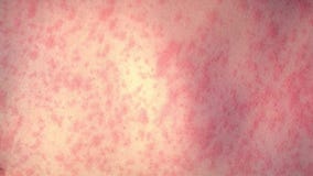 MOA measles warning: Infected child visited on May 24