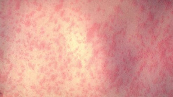MOA measles warning: Infected child visited on May 24