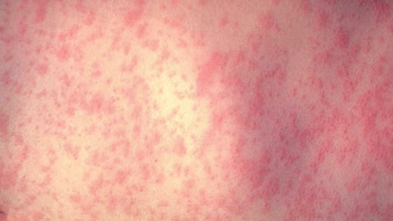 MOA measles warning: Infected child visited on May 24