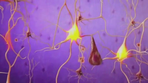 FDA approves new drug for Alzheimer's Disease
