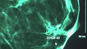 Olivia Munn's breast cancer diagnosis