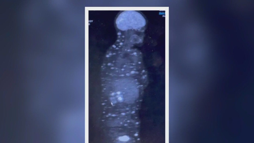 Texas woman raises awareness of skin cancer