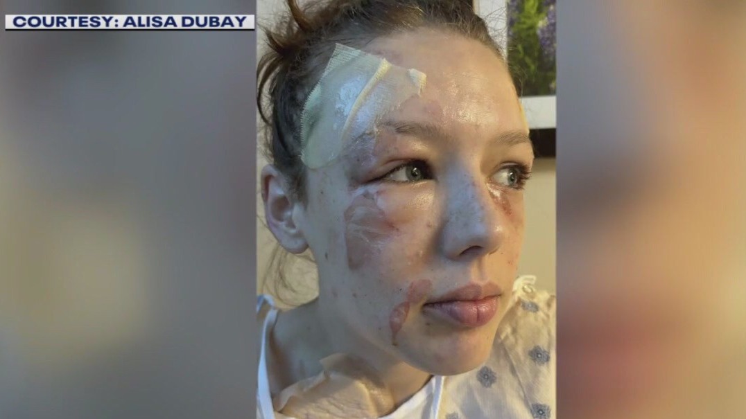 TXST student recovering after grease fire