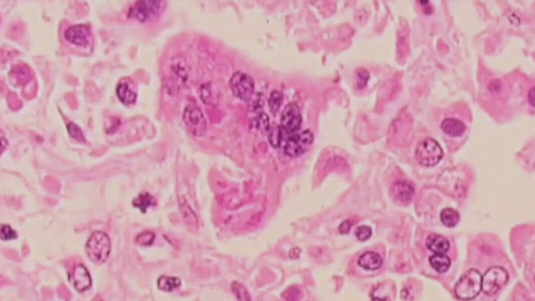 Possible measles exposure in San Marcos