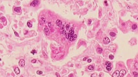 Measles outbreak spreading throughout U.S.