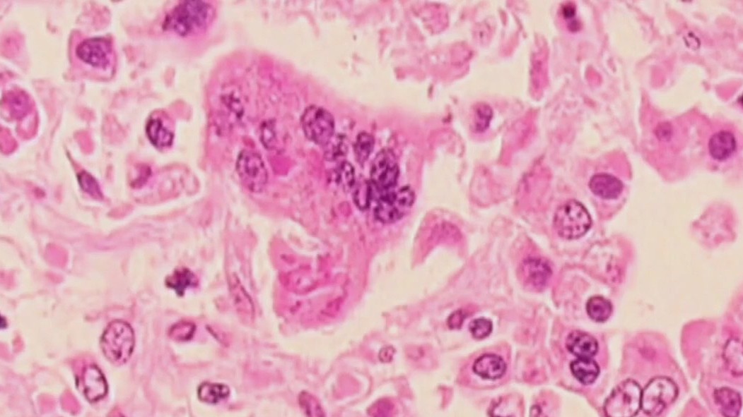 Measles outbreak spreading throughout U.S.