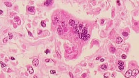 New possible measles exposure in Austin