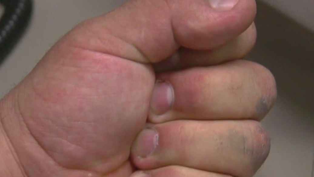 Hand condition can impact daily activities