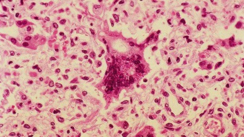 Measles detected in Austin wastewater