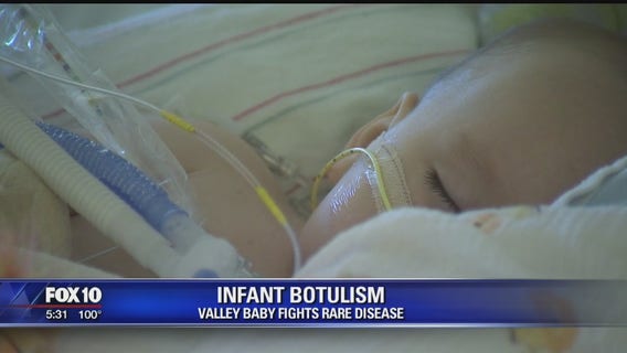 One-year-old Peoria infant recovering from botulism in Glendale hospital