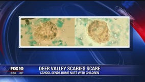Deer Valley Unified School District officials: No Scabies outbreak at school