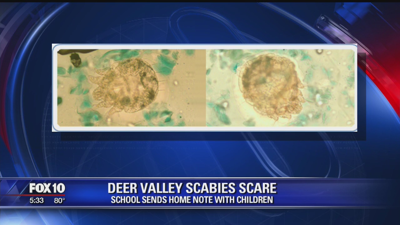 Deer Valley Unified School District officials: No Scabies outbreak at school