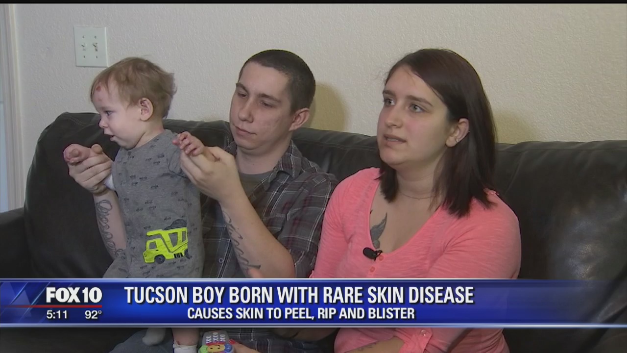 Tucson boy suffers from rare skin disease that makes it hard for his parents to hug him