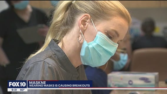Many are experiencing 'maskne' after wearing a face mask during the pandemic