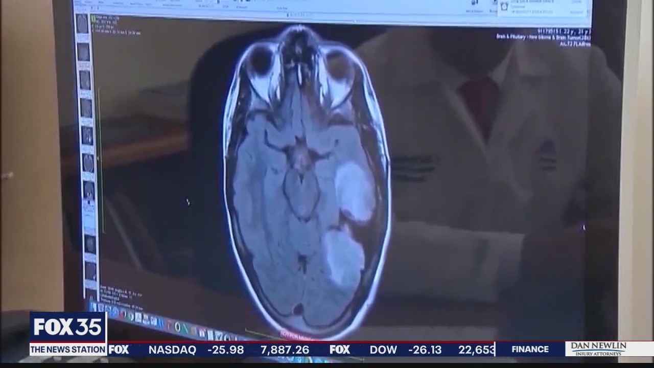 COVID-19 believed to cause heart, brain problems in some