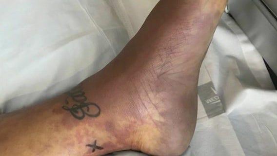 Mom survives flesh-eating bacterial infection