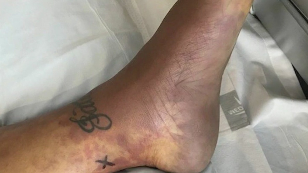 Mom survives flesh-eating bacterial infection