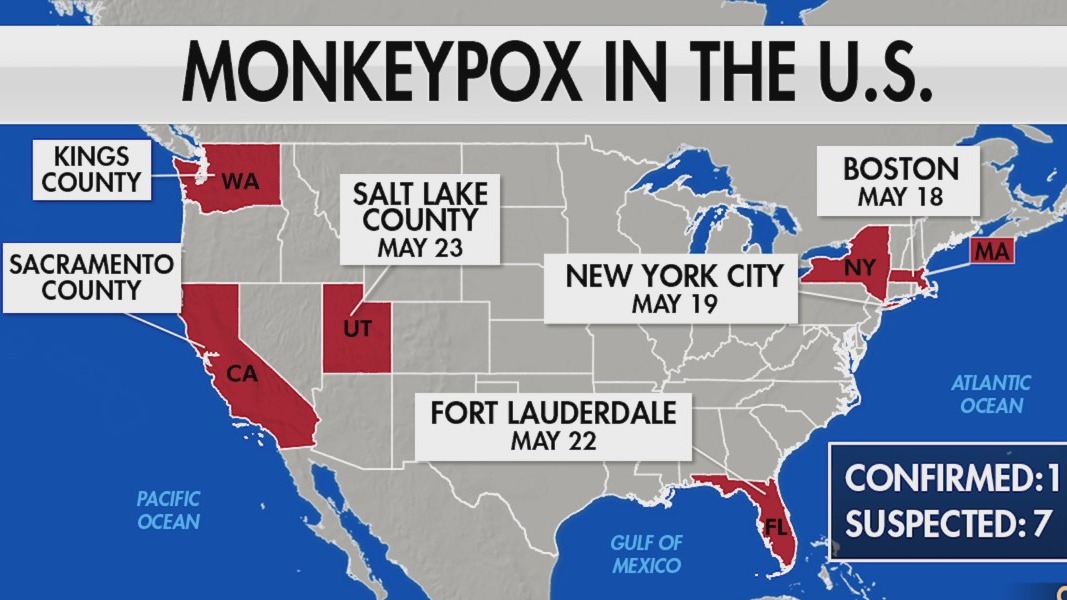 Breaking down the severity of Monkey Pox