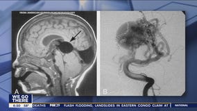 Doctors perform brain surgery on fetus in mother's womb