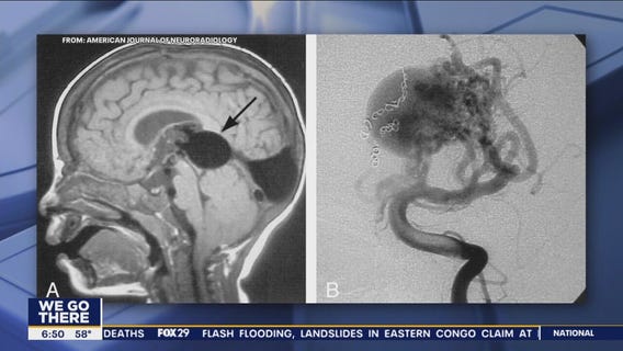 Doctors perform brain surgery on fetus in mother's womb