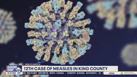 12th case of measles in King County, WA
