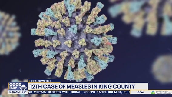 12th case of measles in King County, WA