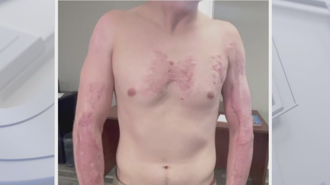 Phoenix PD faces new lawsuit from burn incident