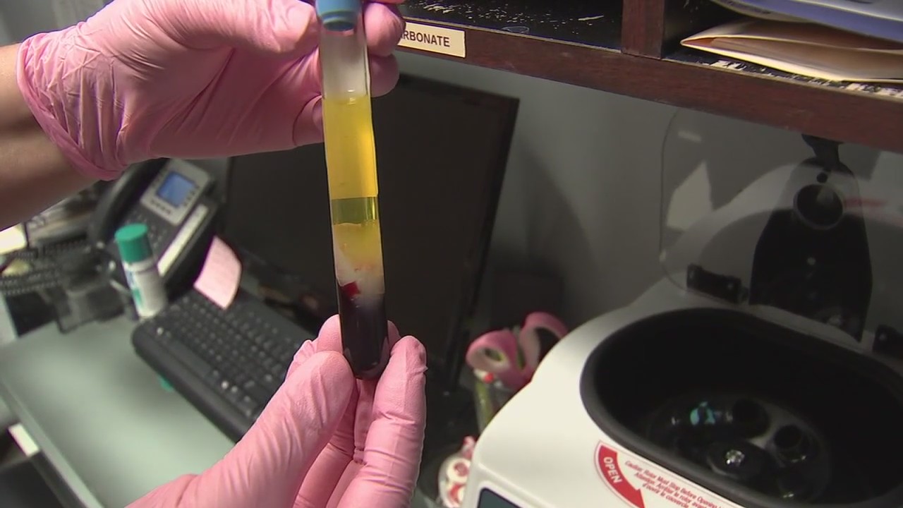 Troy doctor reacts to new warning over vampire facials by CDC