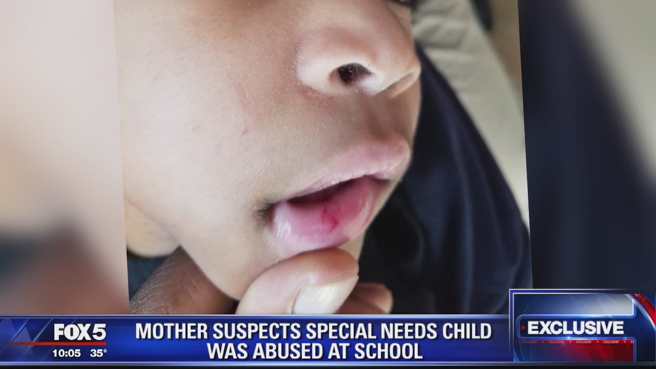 EXCLUSIVE: Mother claims her young daughter with autism was abused at Prince George's County school