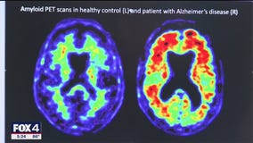 New investigational drug for Alzheimer's disease