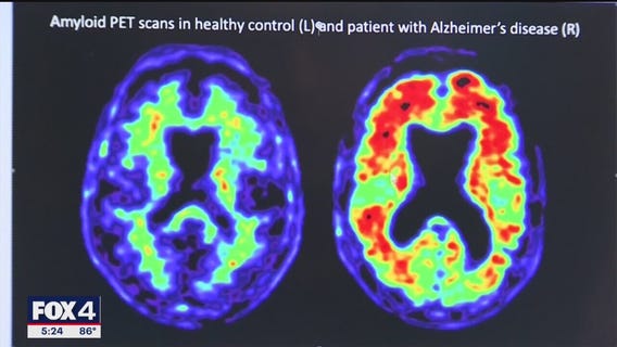 New investigational drug for Alzheimer's disease
