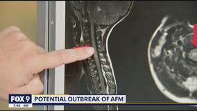CDC warns of potential outbreak of AFM: What parents should be on the lookout for