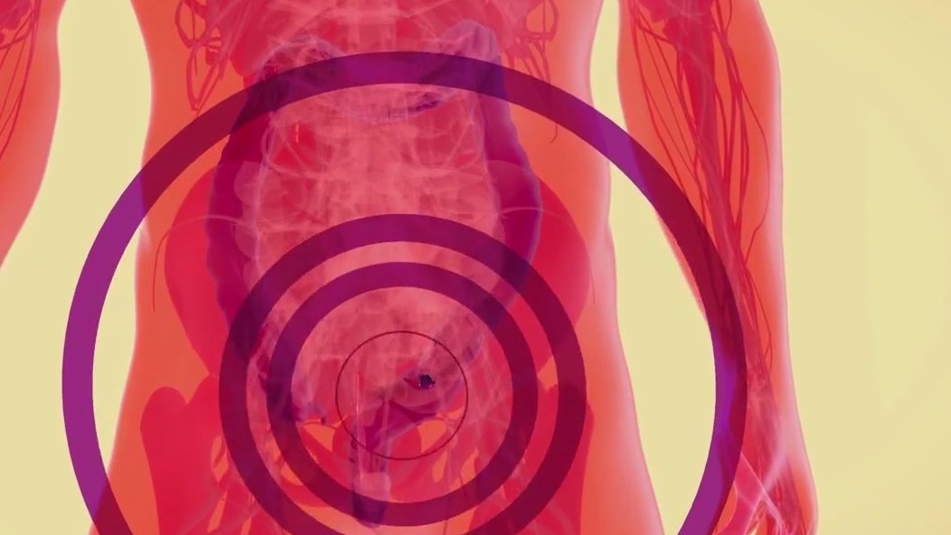 Colon cancer awareness