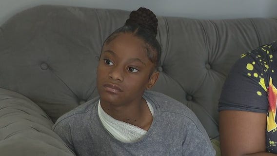 Detroit 11-year-old has acid thrown on her