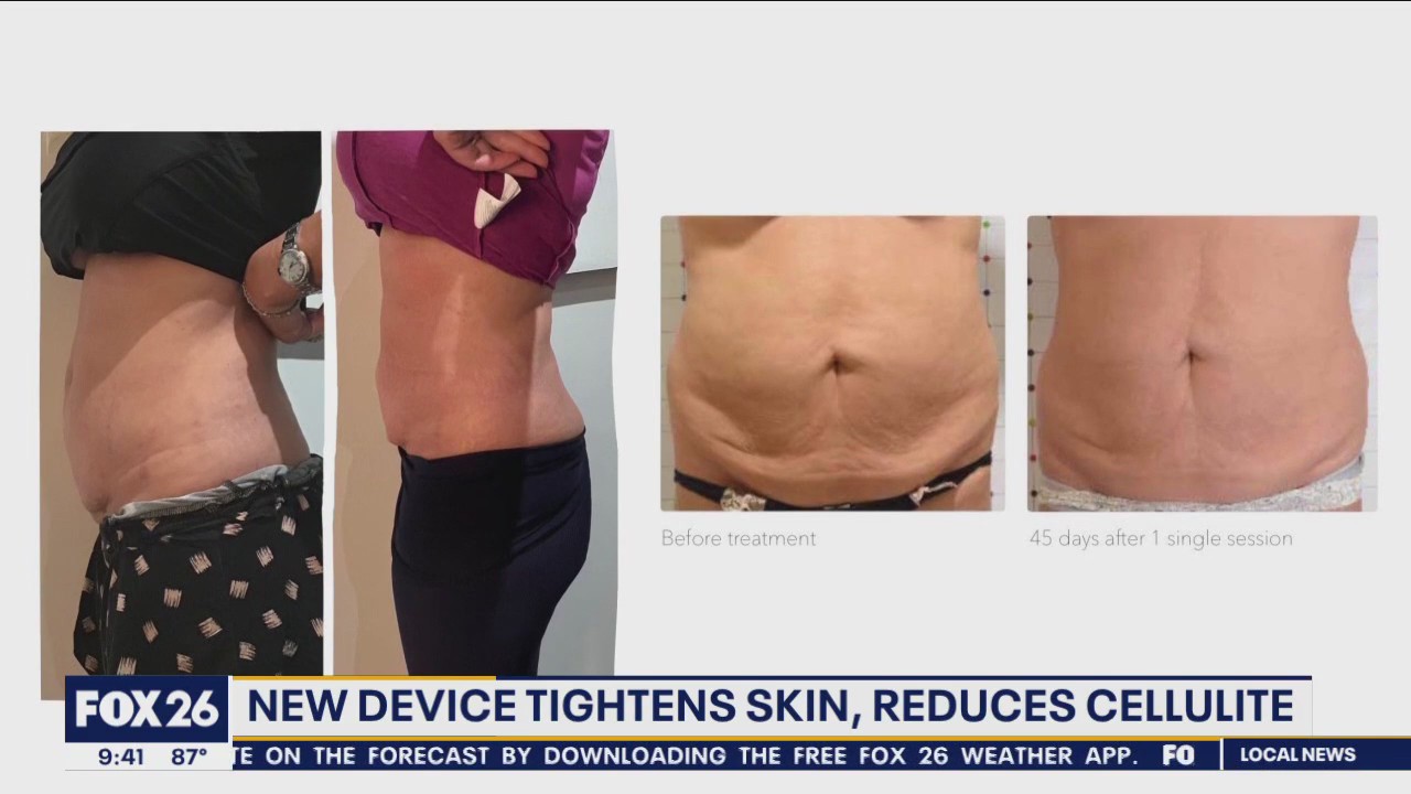 New device tightens skin, reduces cellulite