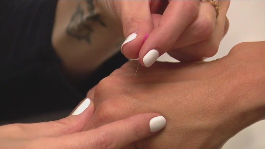 Feel good: Putting acupuncture to the test