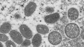 Monkeypox hotline created as cases continue to rise across Houston-area