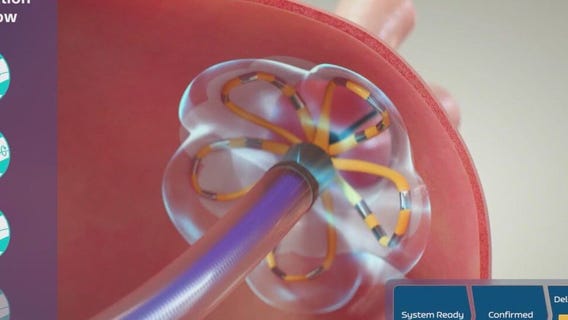 New treatment for atrial fibrillation