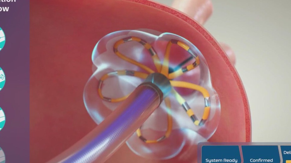 New treatment for atrial fibrillation