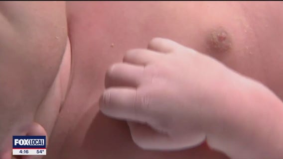 CDC no longer recommends Hep B vaccine for all newborns