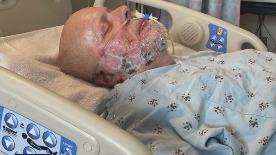 Man seriously burned in LA Metro attack