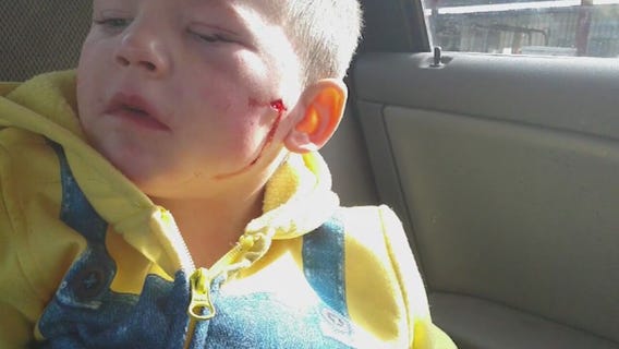 3-year-old boy attacked by pit bull