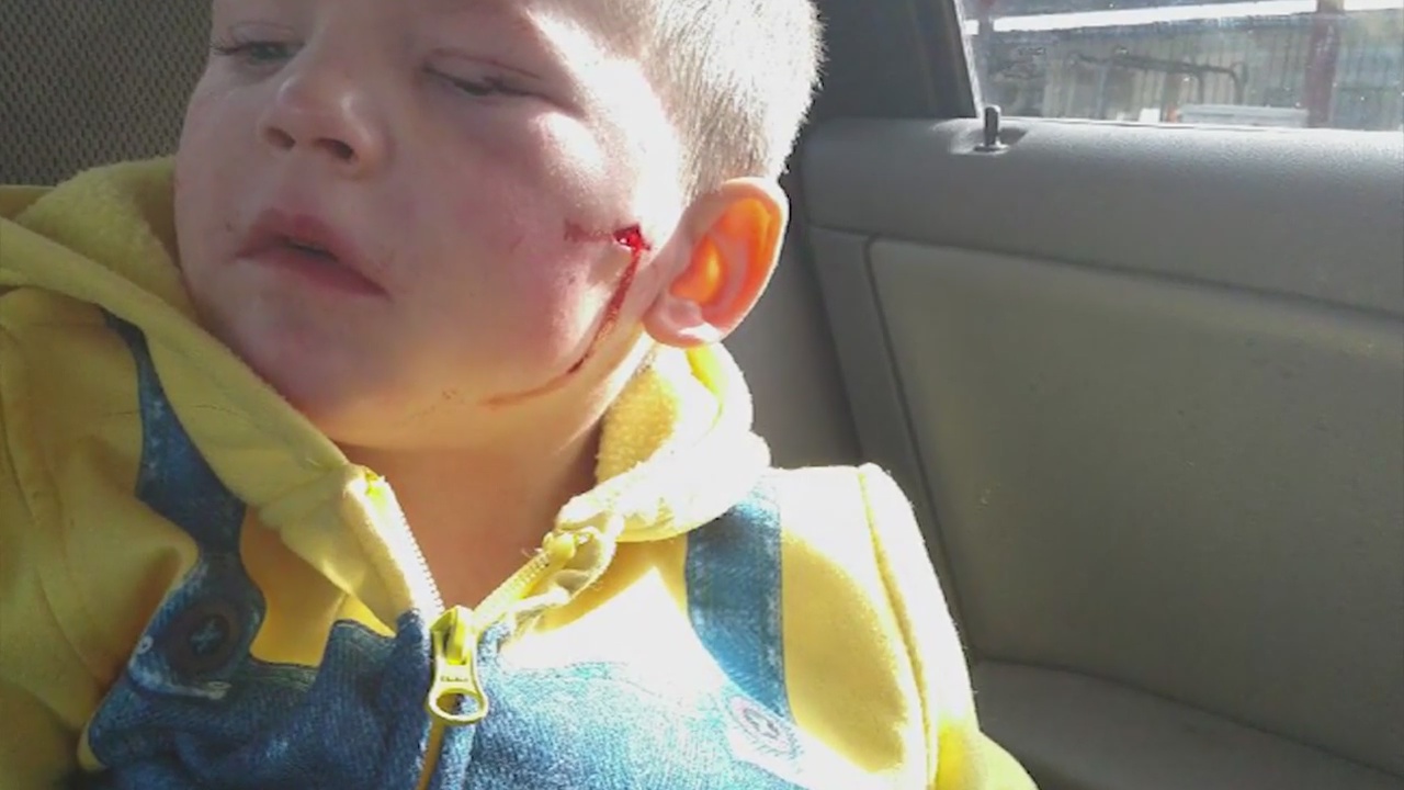 3-year-old boy attacked by pit bull