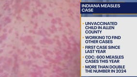 Indiana reports first measles case of 2025