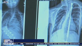 UW: Device helps people with spinal injuries improve hand function